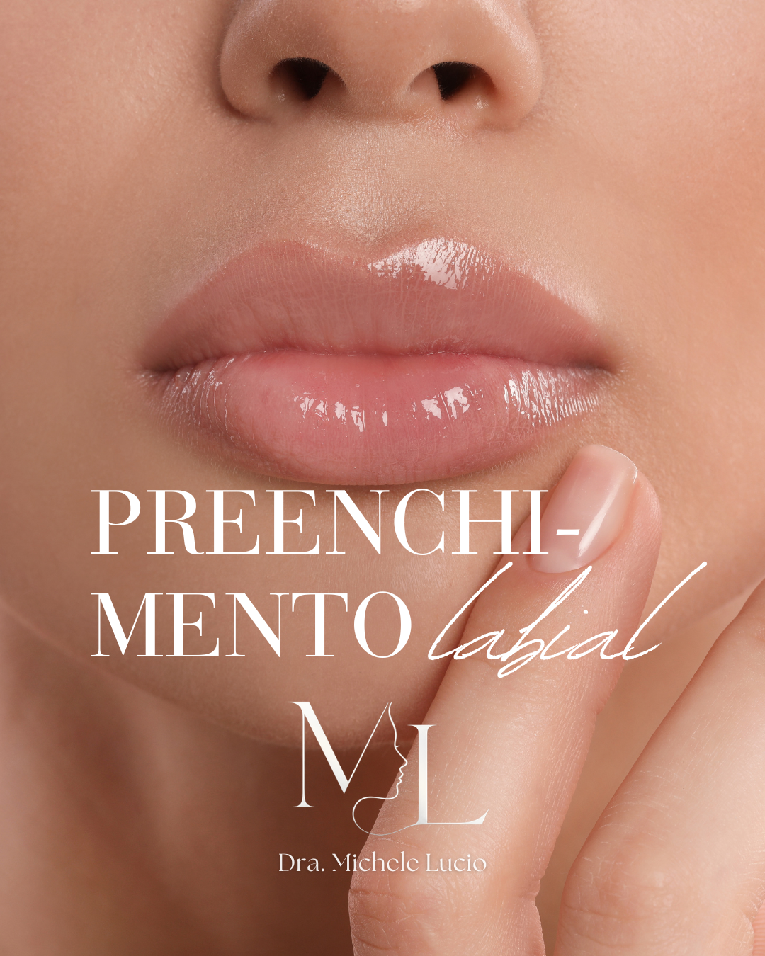 Preenchimento Labial